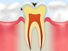 ①初期段階の虫歯の場合