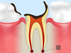 ④歯を保存できない重度の虫歯